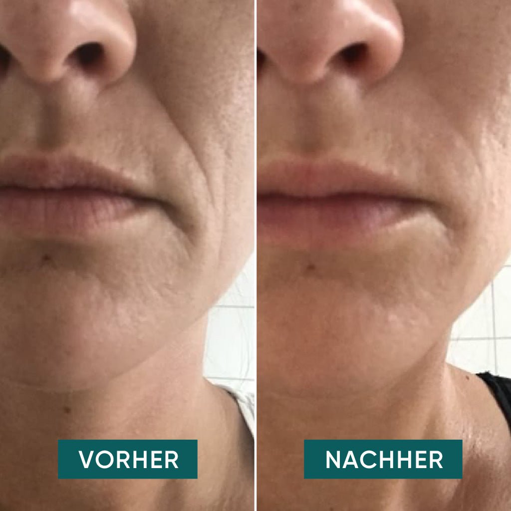 APRICOT I Mund Pads mit Hyaluron "I love your smile" - 30 Behandlungen