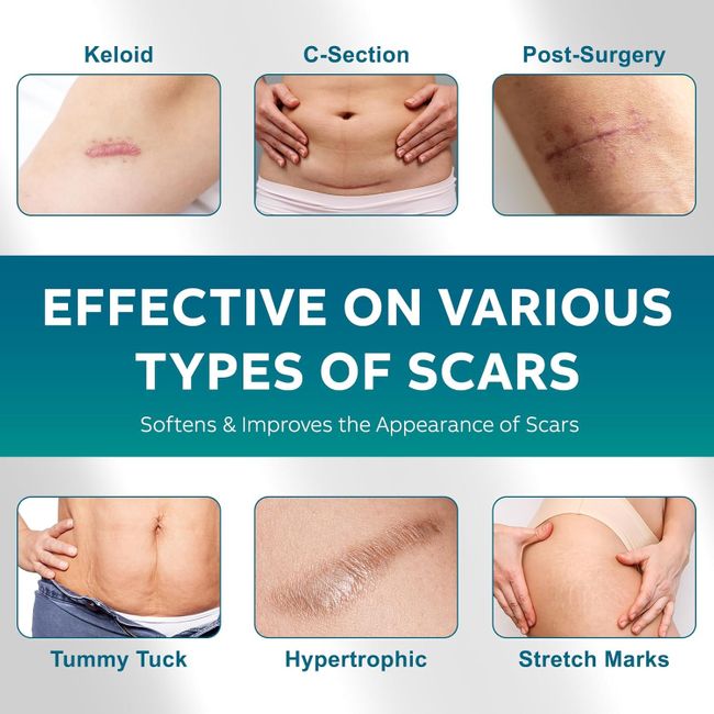 UNIEDI Narbenpflaster - 4cm x 300cm