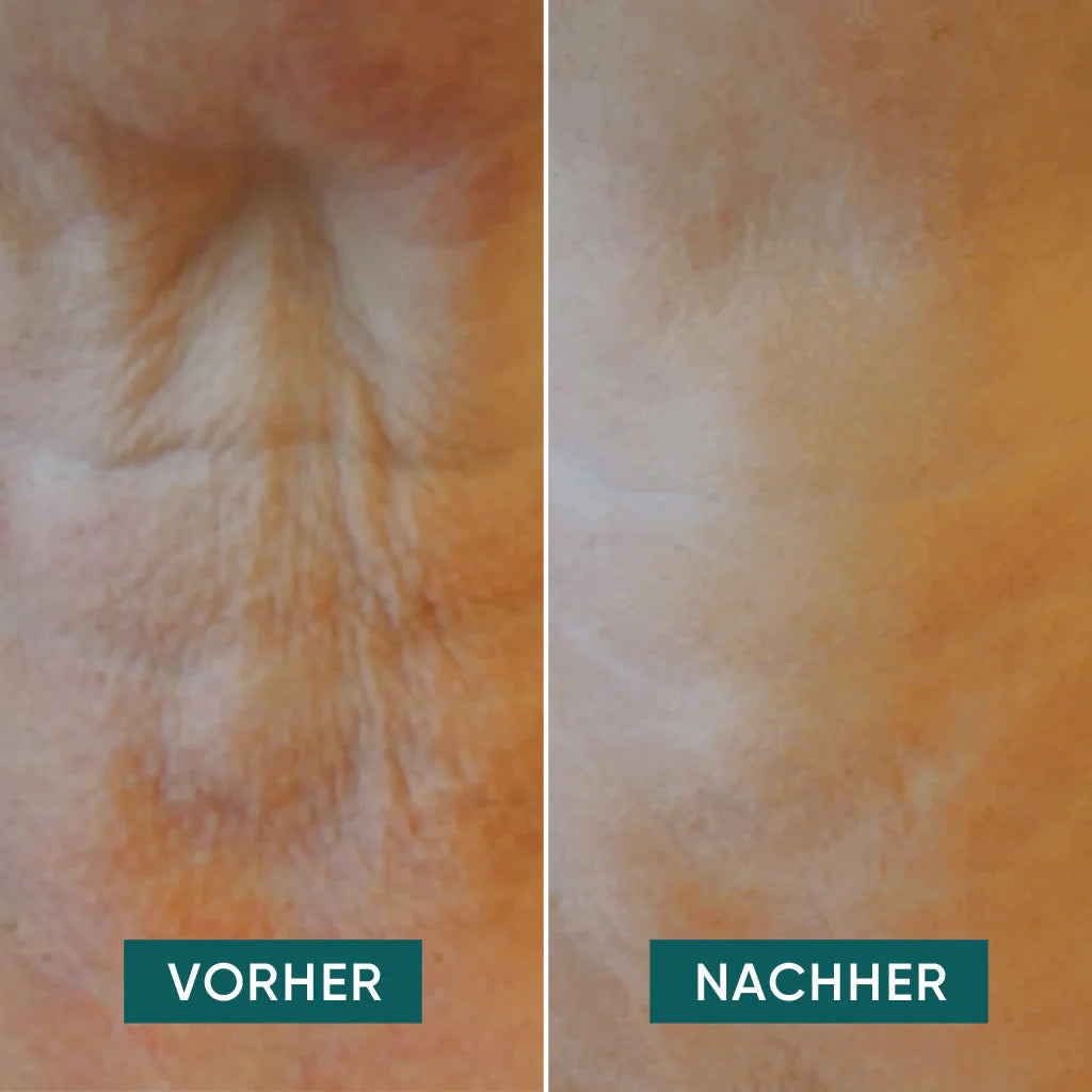 APRICOT I Hals Pads "it's neck or nothing" mit Hyaluron I 30 Behandlungen