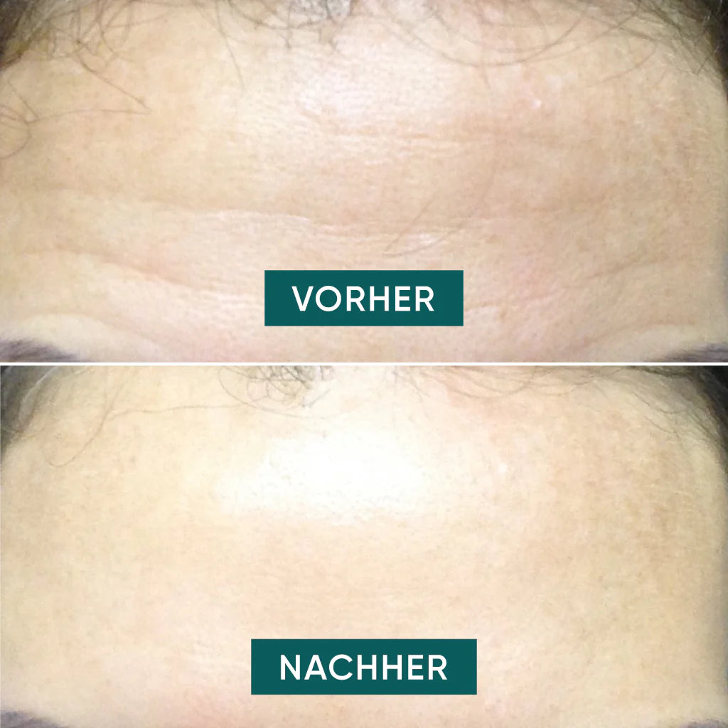 APRICOT I Stirn Pad "fantastic forehead" mit Hyaluron - 30 Behandlungen