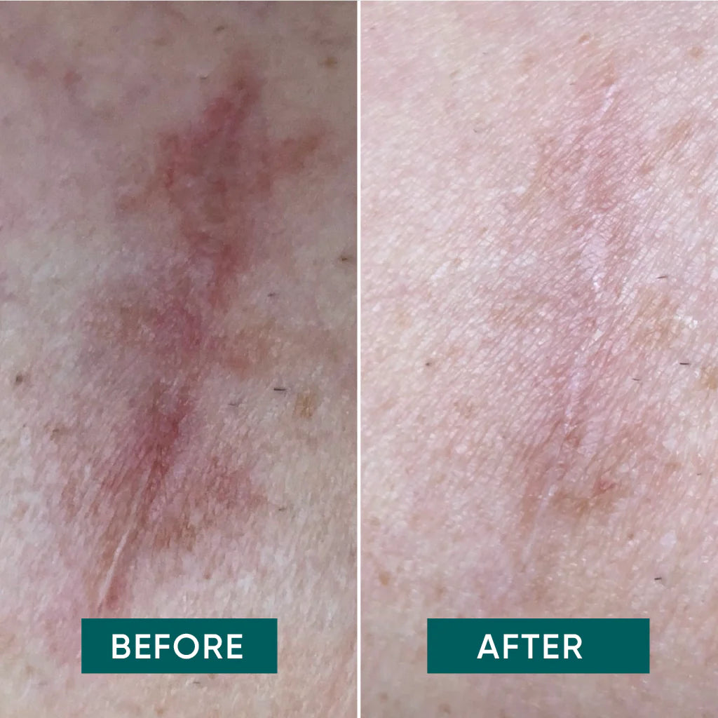 Aloe Vera Narbenbehandlung