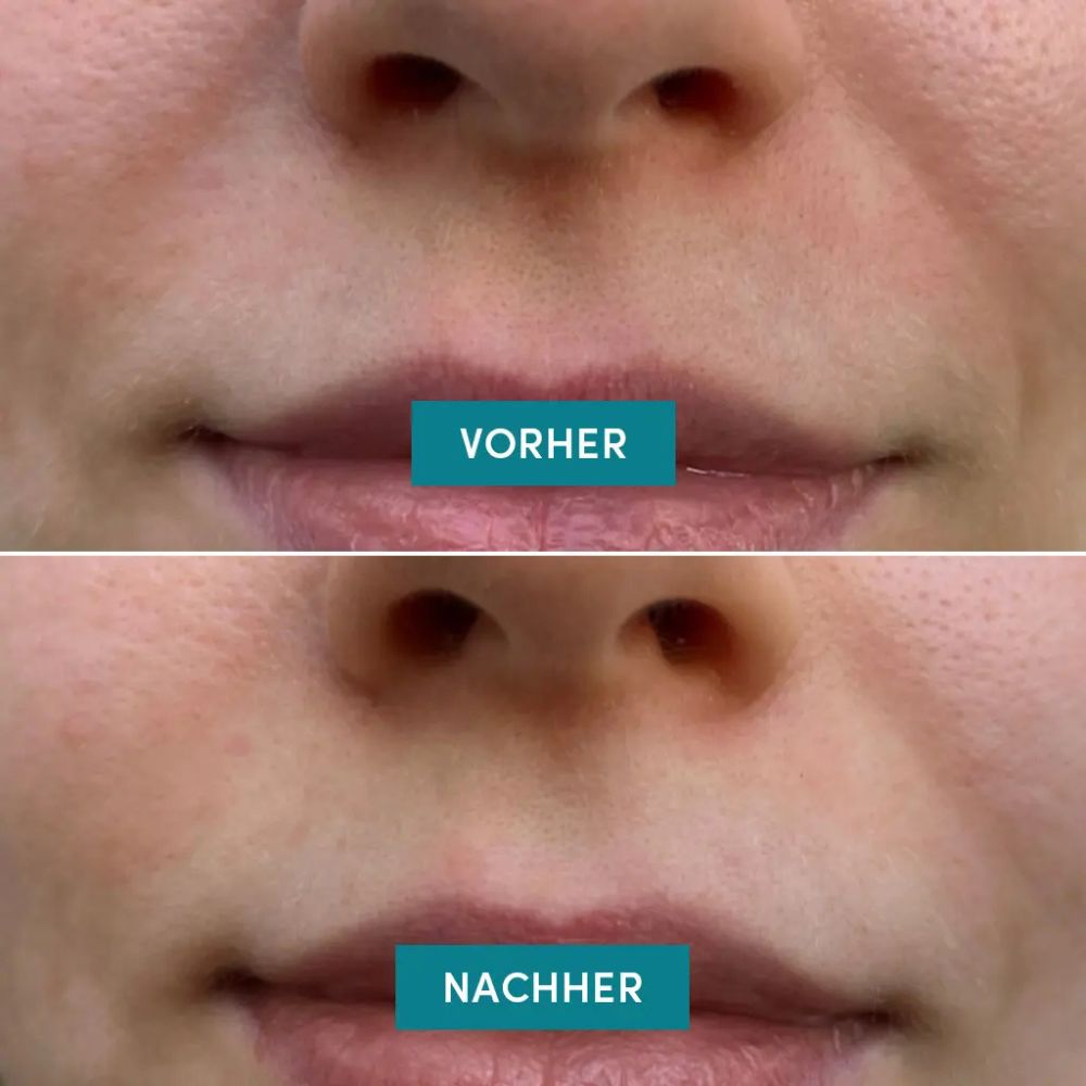 APRICOT | Mund Patches mit Niacinamid - 24 Stück Minipack