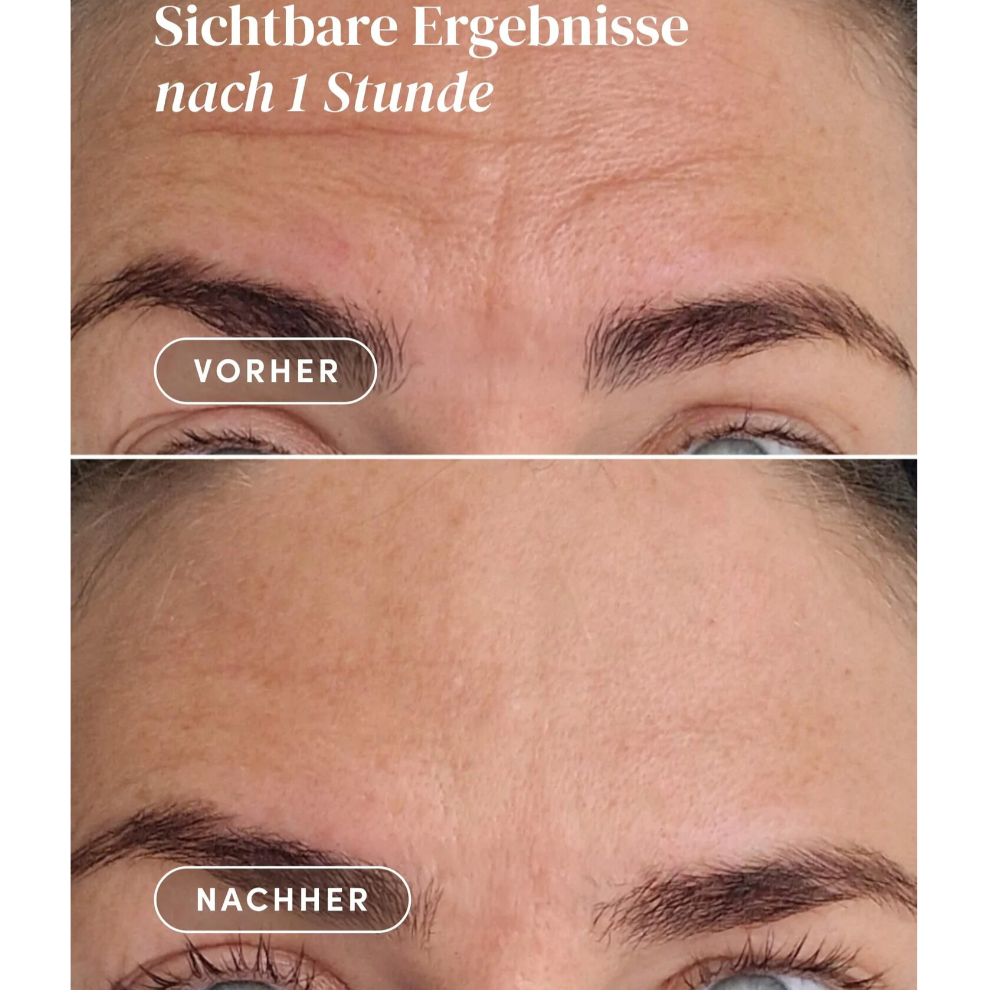 APRICOT | Wiederverwendbares Stirn Pad mit Hexapeptid - 30 Behandlungen