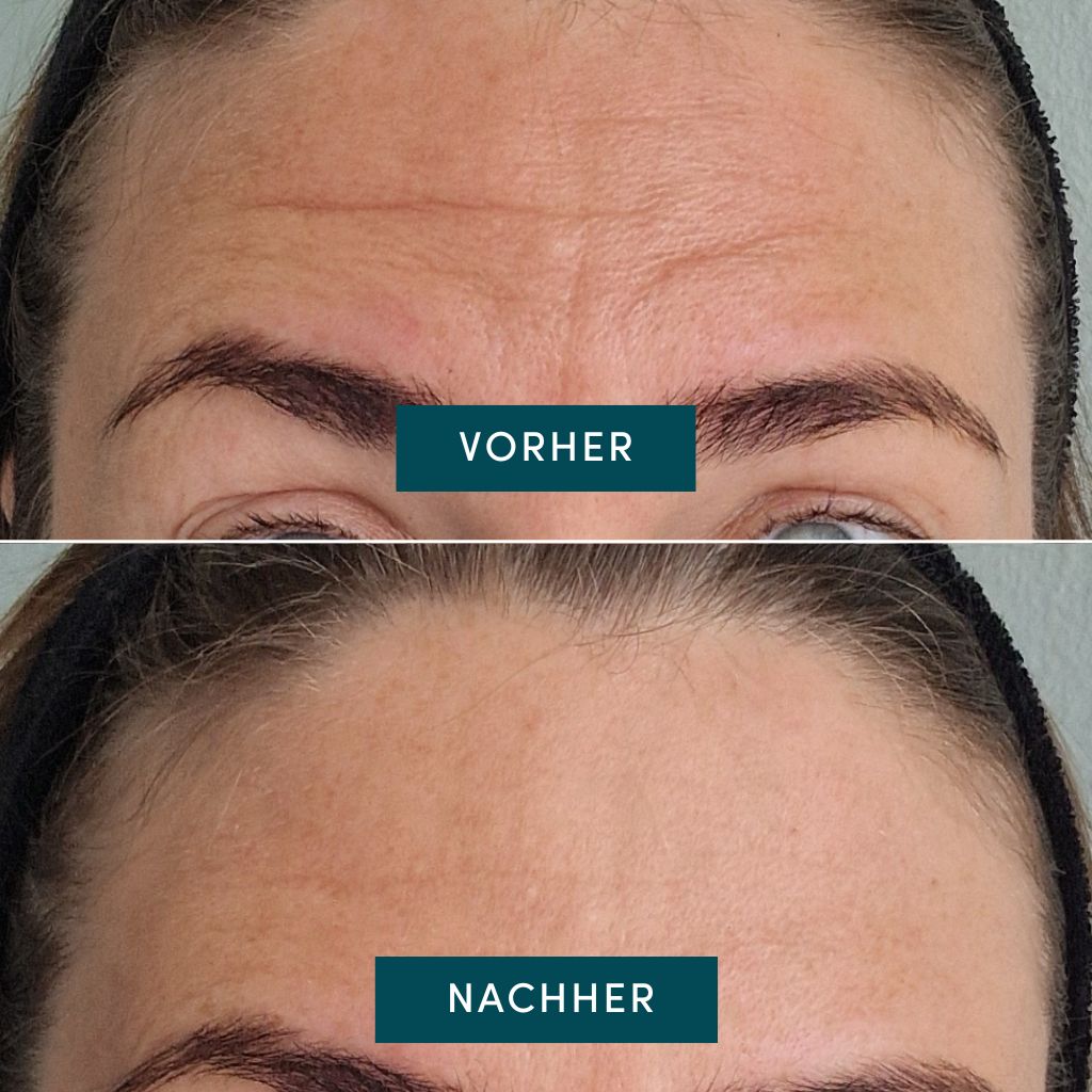 APRICOT I Stirn Pad "fantastic forehead" mit Hyaluron - 30 Behandlungen