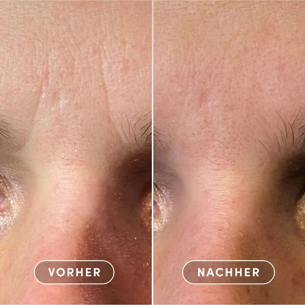 APRICOT | Zornesfalten Patches mit Niacinamid - 24 Stück Minipack