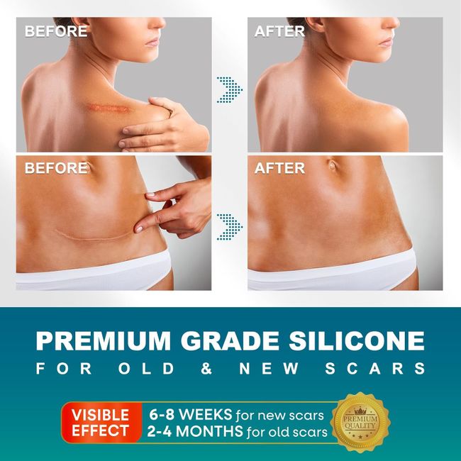 UNIEDI Narbenpflaster - 4cm x 300cm