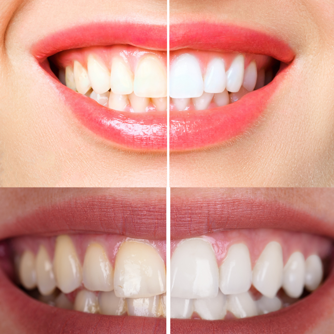 OptiSmile | Colour Corrector Zahnaufhellungsstreifen - 14x2 Behandlungen